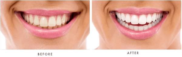 provadent-before-after-smile-health-care